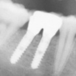 bronx-dental-implant-problems