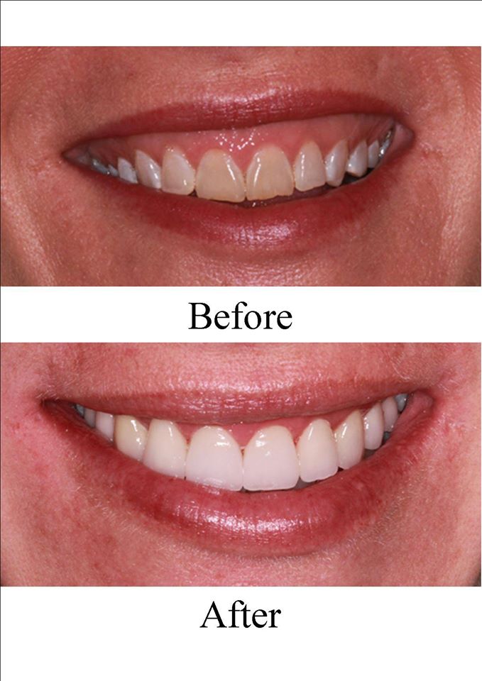 Dentures Morris Park Dental